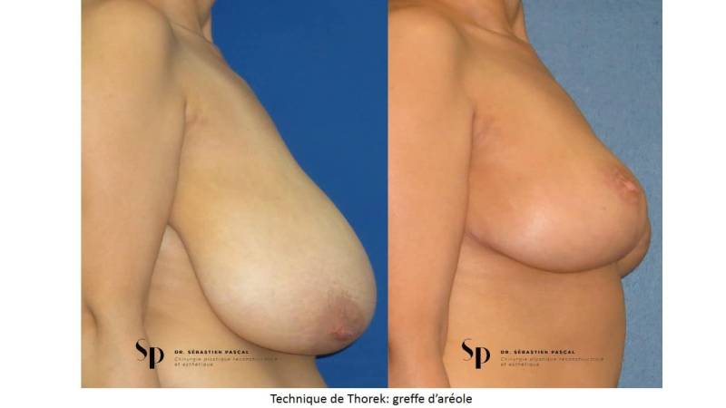 Poitrine – Réduction mammaire et hypertrophie mammaire