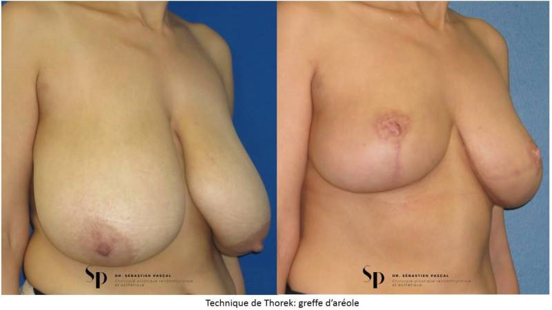 Poitrine – Réduction mammaire et hypertrophie mammaire