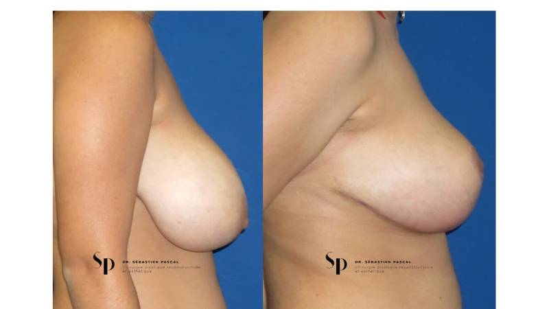 Poitrine – Réduction mammaire et hypertrophie mammaire