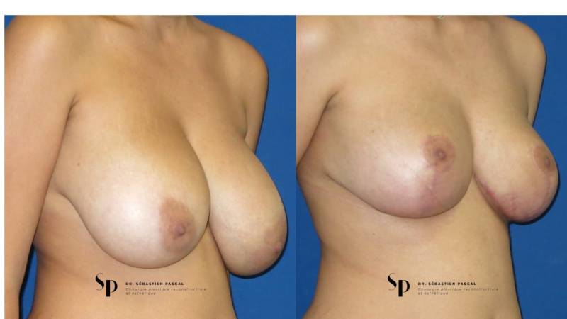 Poitrine – Réduction mammaire et hypertrophie mammaire