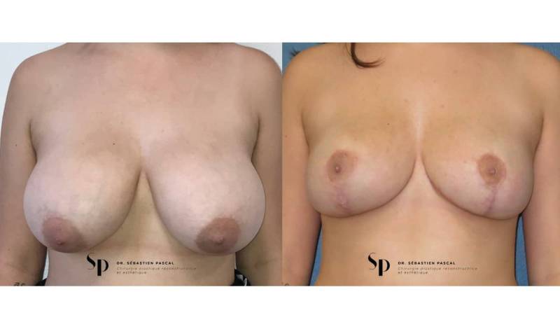 Poitrine – Réduction mammaire et hypertrophie mammaire