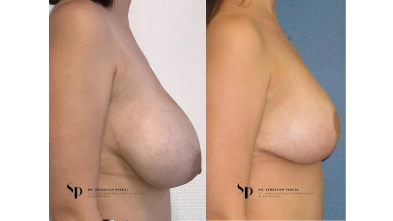Poitrine – Réduction mammaire et hypertrophie mammaire