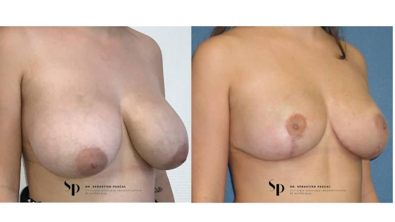 Poitrine – Réduction mammaire et hypertrophie mammaire