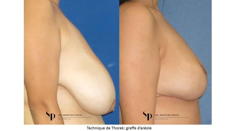 Poitrine – Réduction mammaire et hypertrophie mammaire