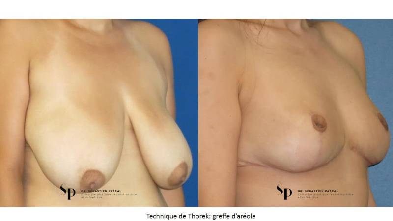 Poitrine – Réduction mammaire et hypertrophie mammaire