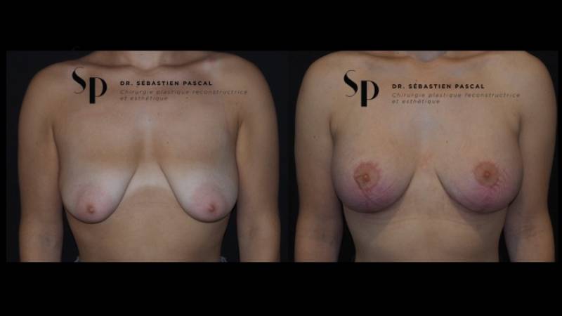 Poitrine - Cure de ptose mammaire AVEC PROTHESES (2)