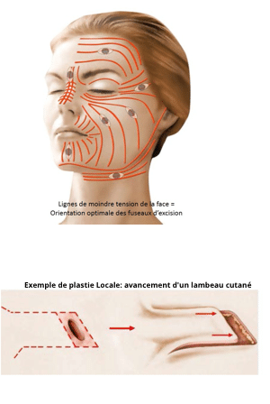 Chirurgie plastique pour traitement et Reprise de Cicatrices